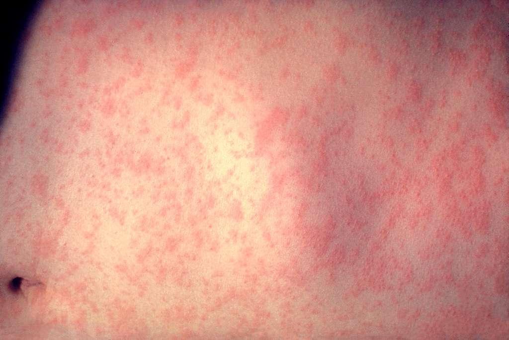 morbillivirus-measles-infection-f5881a%20%281%29